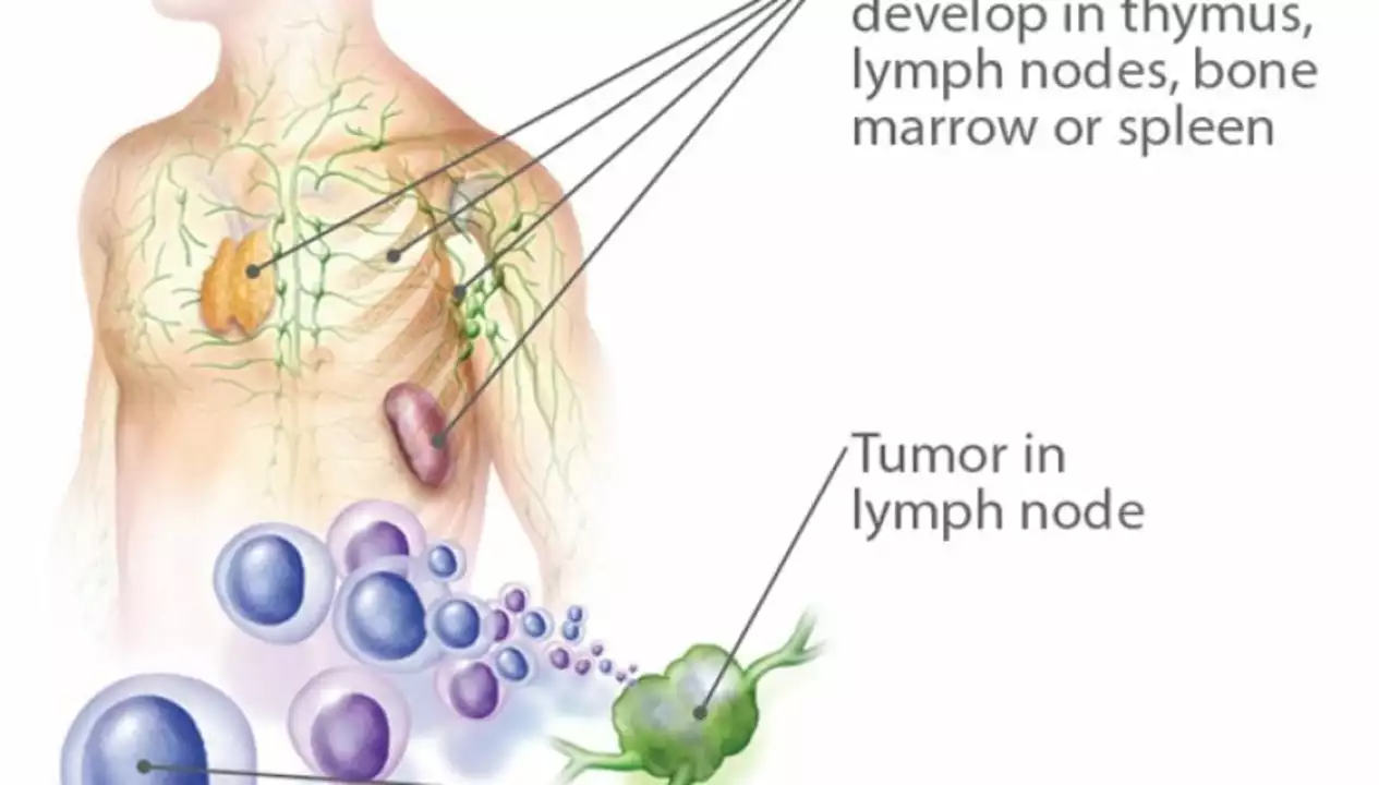 How Hodgkin's Disease Affects the Lymphatic System